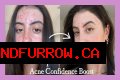 How To Feel Confident With Acne?